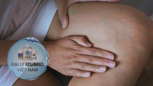 Bà bầu bị nổi gân xanh
