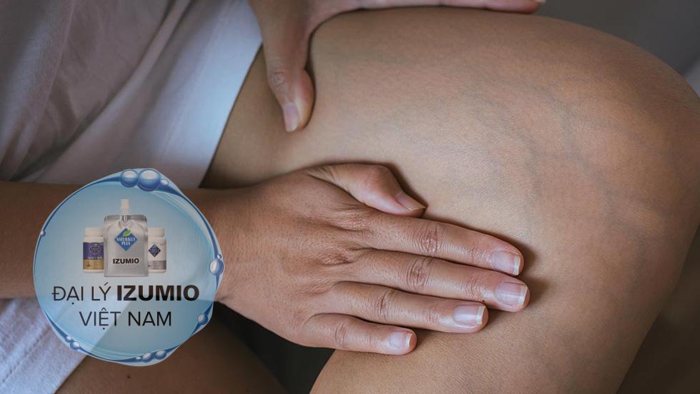 Bà bầu bị nổi gân xanh