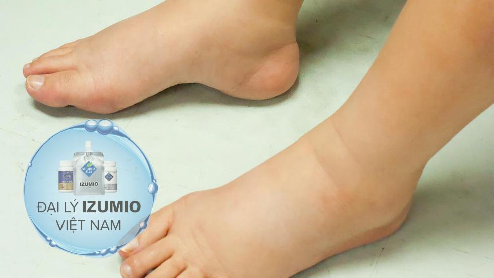 Phù chân sau sinh mổ
