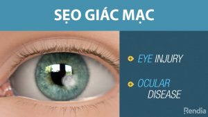 sẹo giác mạc có hết không