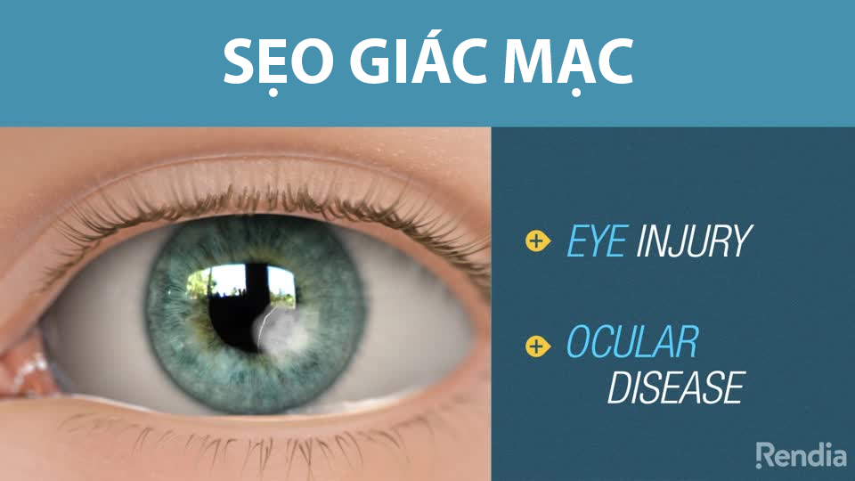 sẹo giác mạc có hết không